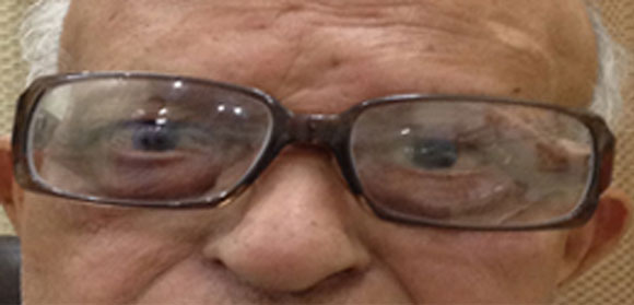 spectacle orbital prosthesis
